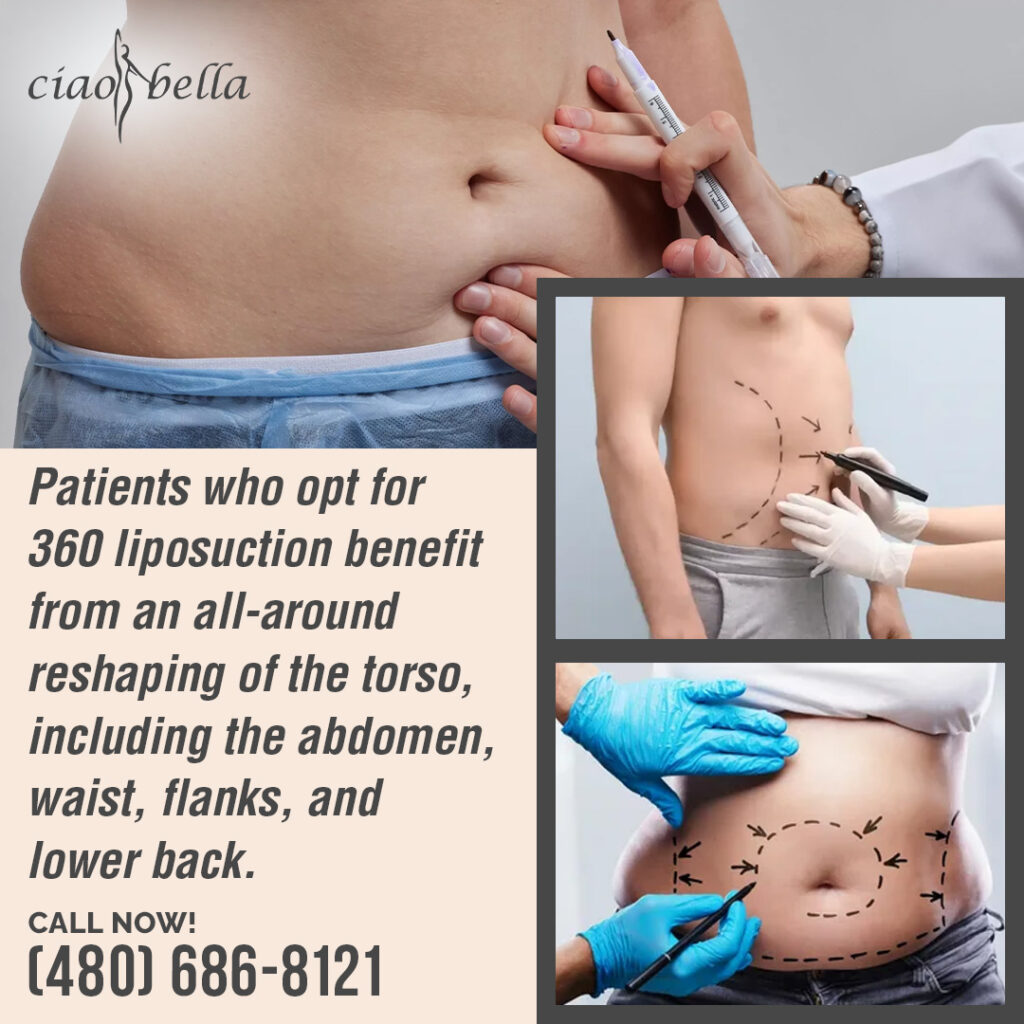 360 liposuction results